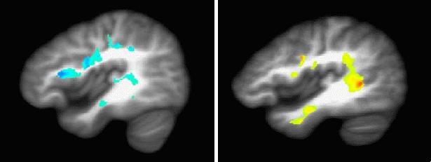 diffusion tensor imaging marijuana use versus healthy teens brain